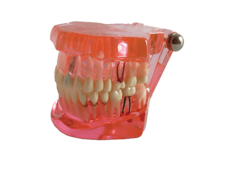 Educational Restoration Model w/Implant, A26